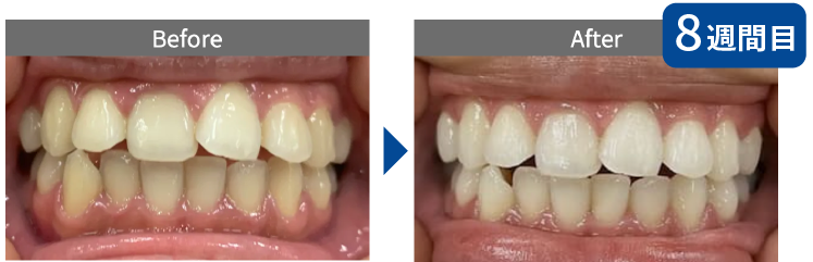 ホームホワイトニングの症例画像