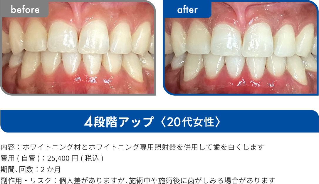 4段階アップ 20代女性