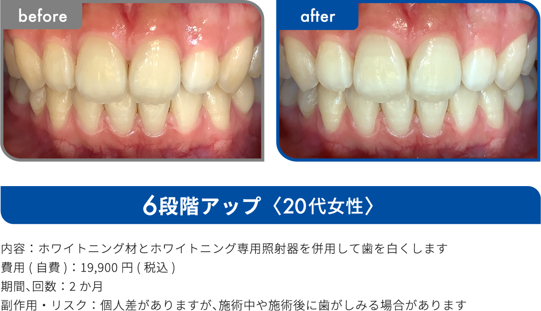 6段階アップ 20代女性